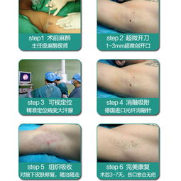 腋臭,術(shù)后,注意事項(xiàng),微創(chuàng)