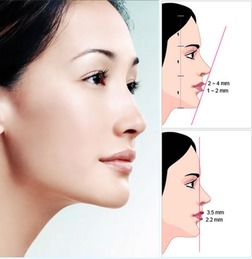 自體細胞生長肽填充下巴注意事項