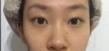 微整鼻子后的注意事項(xiàng)