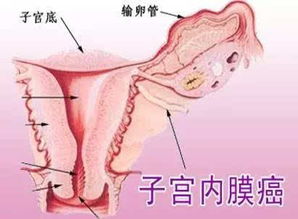 子宮內(nèi)膜癌化療注意事項
