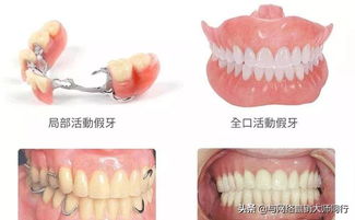 活動義齒的注意事項,活動義齒佩戴注意事項,活動義齒的適應(yīng)癥和禁忌癥