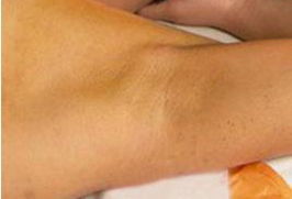 做了微創(chuàng)腋臭手術(shù)后注意事項(xiàng),做完腋臭微創(chuàng)注意事項(xiàng),腋臭術(shù)后飲食注意事項(xiàng)