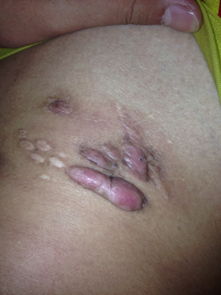 闌尾炎開(kāi)刀注意事項(xiàng)