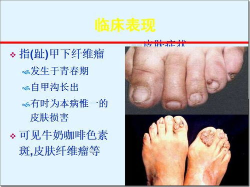 結(jié)節(jié)性硬化癥注意事項(xiàng)