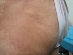 小孩得硬皮病注意事項(xiàng)