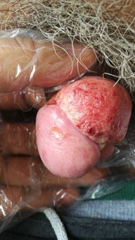 陰莖,激光,注意事項(xiàng)