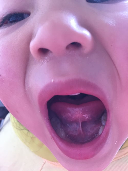 舌細帶手術注意事項