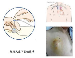 乳腺癌術(shù)前化療注意事項,乳腺癌術(shù)后化療注意事項,乳腺癌化療后注意事項