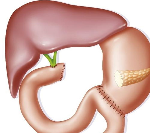 糜爛,注意事項,飲食,十二指腸