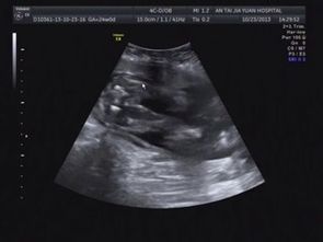 小男孩膀胱b超注意事項(xiàng)