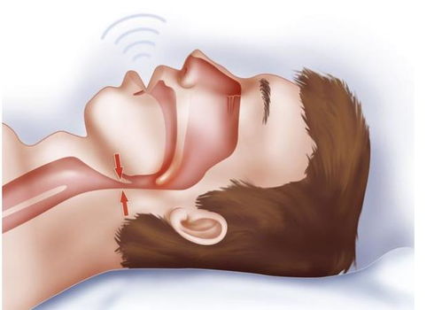 口咽通氣法的注意事項
