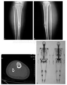脛骨,注意事項,細胞,飲食