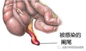 闌尾炎,開(kāi)刀,注意事項(xiàng)