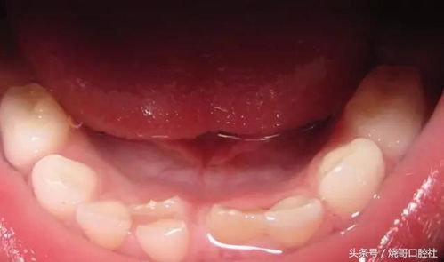 兒童補牙后注意事項有哪些,小孩補牙后注意事項,補牙后的注意事項