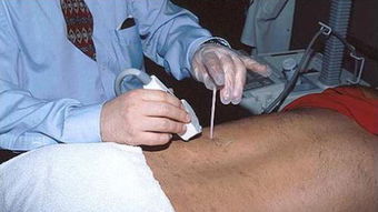 腎穿刺后的注意事項,做完腎穿刺的注意事項,做過腎穿刺后注意事項