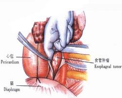 賁門癌手術后注意事項