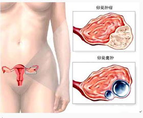 手術(shù)后,注意事項,卵巢癌