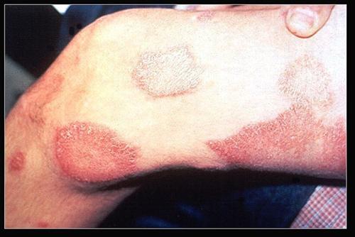 麻風(fēng)疫苗紅疹注意事項(xiàng)