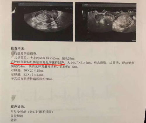 瘢痕子宮引產(chǎn)注意事項(xiàng)