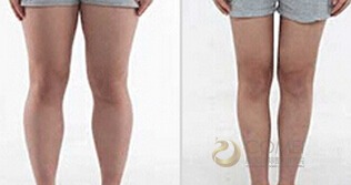 大腿抽脂術(shù)后注意事項,大腿抽脂后的注意事項,大腿抽脂前注意事項