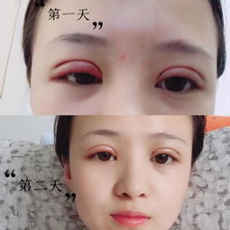 縫完雙眼皮注意事項(xiàng)