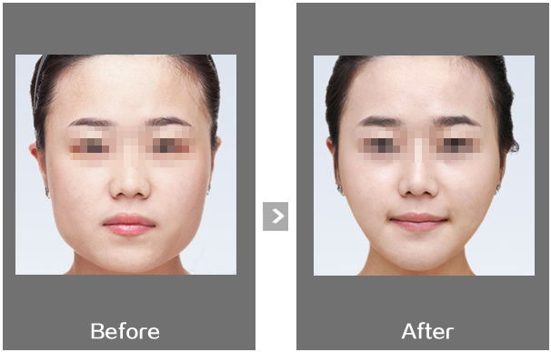 瘦臉針打后的注意事項