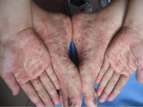 注意事項,上藥,hiv