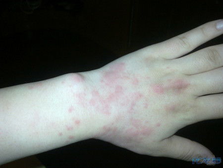 蕁麻疹,注意事項(xiàng),變應(yīng)性