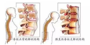 未分化脊柱關(guān)節(jié)炎注意事項,單發(fā)性關(guān)節(jié)炎注意事項,創(chuàng)傷性關(guān)節(jié)炎的注意事項