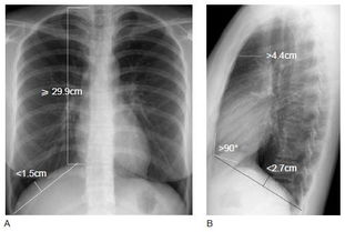 肺氣腫上青海的注意事項(xiàng)