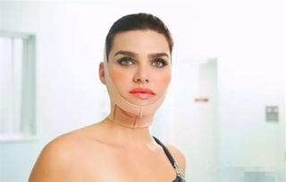 臉部光釬溶脂后注意事項