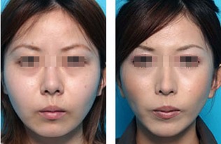 打溶脂針瘦臉注意事項(xiàng)