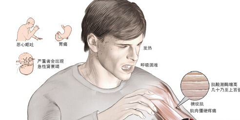 橫紋肌溶解癥治好后就注意事項