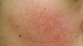 各種肌膚形成的原因和注意事項