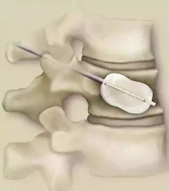 腰椎,注意事項,壓縮,飲食
