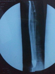 上消化道鋇餐造影注意事項(xiàng),鋇餐造影做完后注意事項(xiàng),鋇餐灌腸造影注意事項(xiàng)