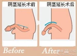 陰莖,注意事項,手術