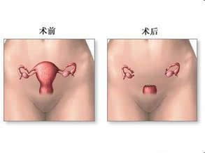 子宮次全切除術(shù)后注意事項(xiàng)