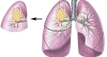 肺癌手術(shù)后應(yīng)注意事項(xiàng),胸腔手術(shù)后應(yīng)注意事項(xiàng),鼓膜手術(shù)后應(yīng)注意事項(xiàng)