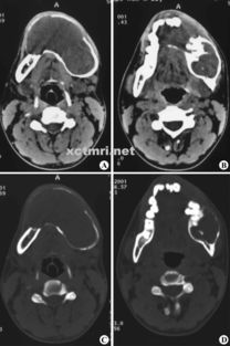 造釉細胞瘤術后注意事項,脛骨造釉細胞瘤臨床表現,脛骨造釉細胞瘤存活率