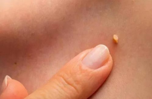 皮肌炎恢復期要注意事項,皮肌炎的注意事項,皮肌炎日常注意事項