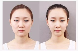 面部抽脂術(shù)后注意事項(xiàng),抽脂手術(shù)前后注意事項(xiàng),面部刷酸前后注意事項(xiàng)