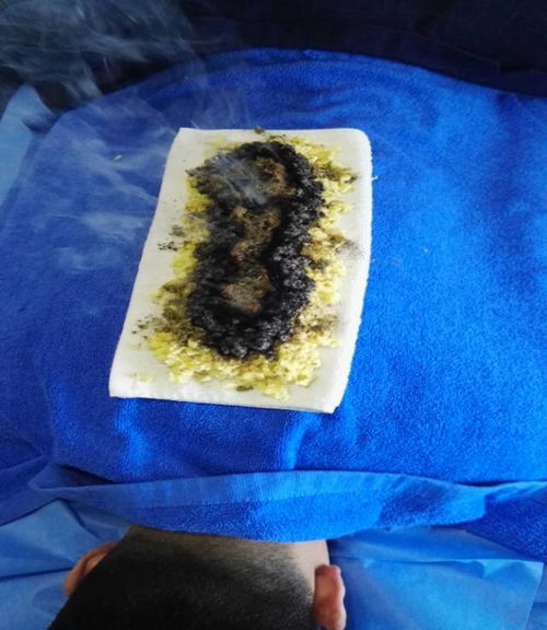 注意事項(xiàng),長(zhǎng)蛇灸