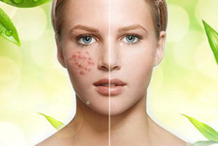 去除青春痘注意事項(xiàng)