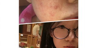 臉部過(guò)敏發(fā)注意事項(xiàng)