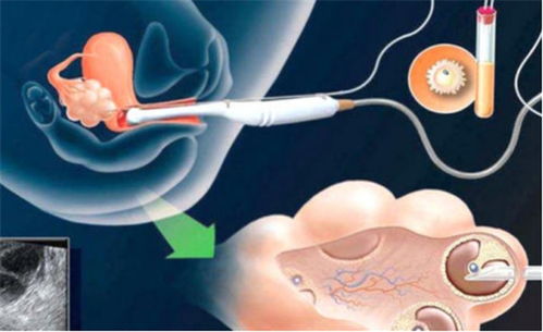 試管嬰兒,注意事項