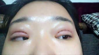 全切雙眼皮術(shù)后注意事項(xiàng),做完全切雙眼皮注意事項(xiàng)有哪些,全切雙眼皮注意事項(xiàng)有哪些