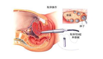 試管嬰兒取卵前后的注意事項,試管嬰兒取卵術后注意事項,試管嬰兒取卵注意事項及經驗