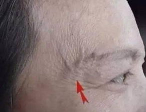 眼睛毛細(xì)血管出血注意事項(xiàng),毛細(xì)血管采血法的注意事項(xiàng),毛細(xì)血管肺炎出院后注意事項(xiàng)