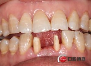 修復(fù),注意事項,全瓷冠